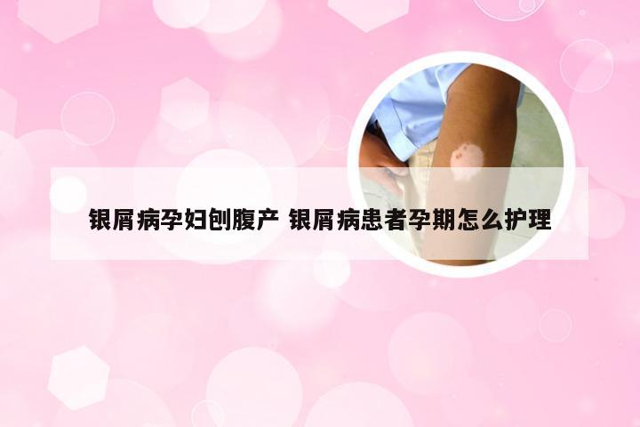 银屑病孕妇刨腹产 银屑病患者孕期怎么护理