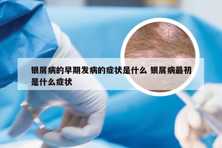 银屑病的早期发病的症状是什么 银屑病最初是什么症状