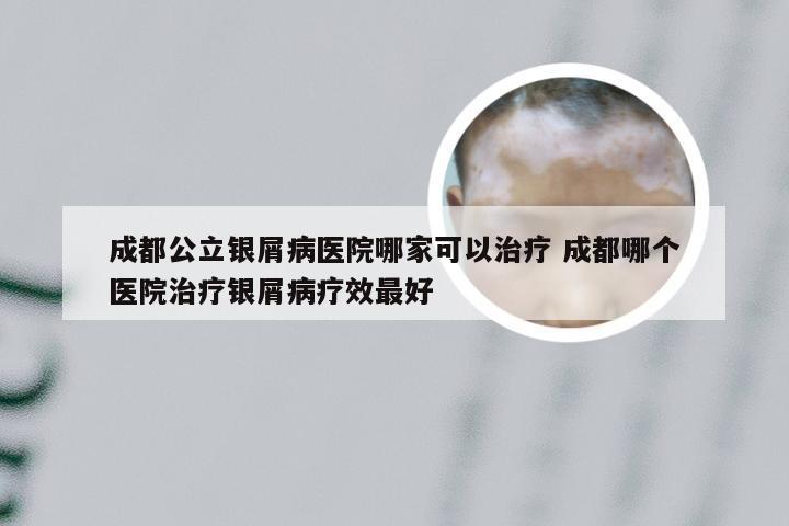 成都公立银屑病医院哪家可以治疗 成都哪个医院治疗银屑病疗效最好