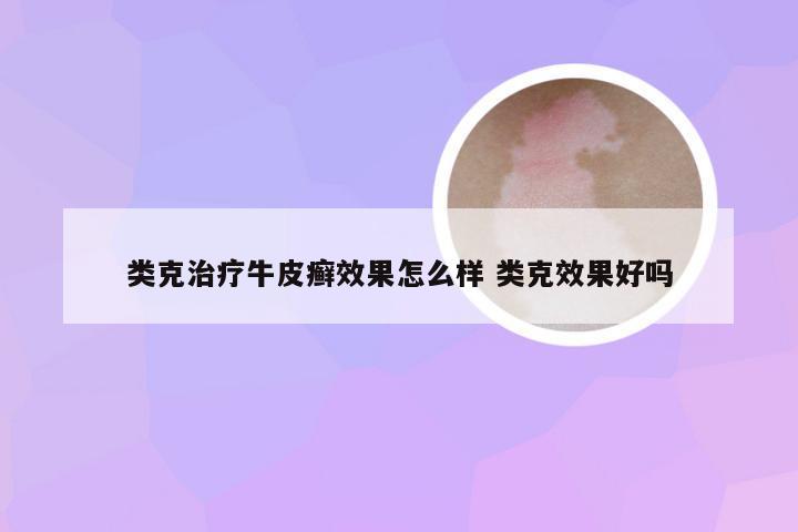 类克治疗牛皮癣效果怎么样 类克效果好吗