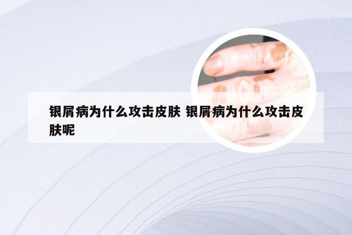银屑病为什么攻击皮肤 银屑病为什么攻击皮肤呢