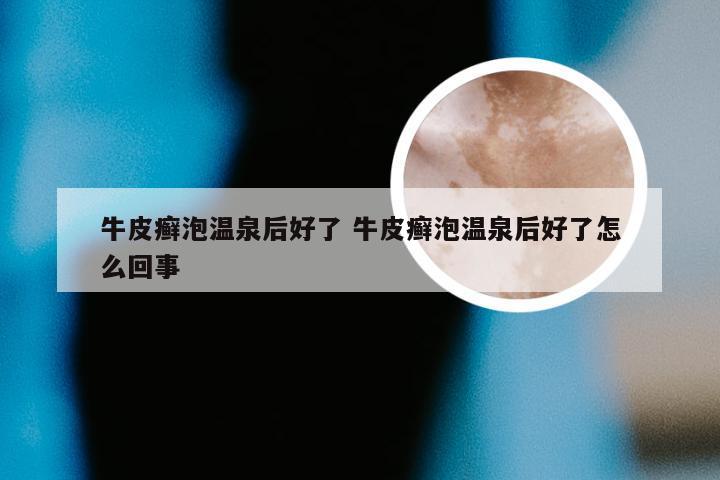 牛皮癣泡温泉后好了 牛皮癣泡温泉后好了怎么回事