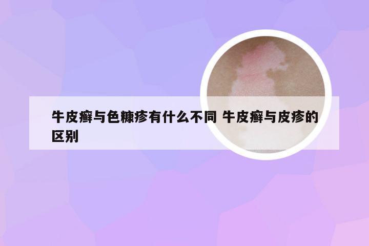 牛皮癣与色糠疹有什么不同 牛皮癣与皮疹的区别