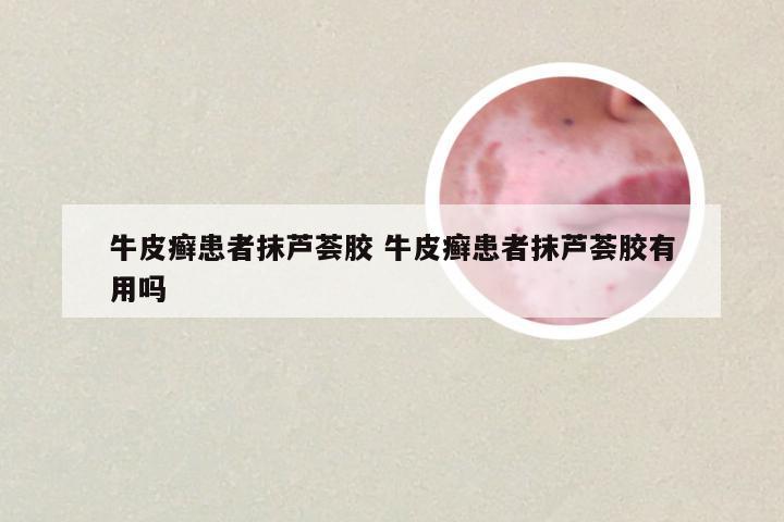 牛皮癣患者抹芦荟胶 牛皮癣患者抹芦荟胶有用吗