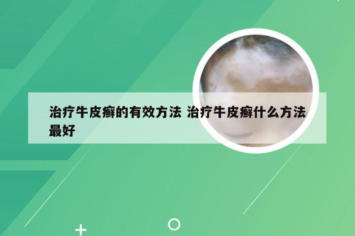 治疗牛皮癣的有效方法 治疗牛皮癣什么方法最好