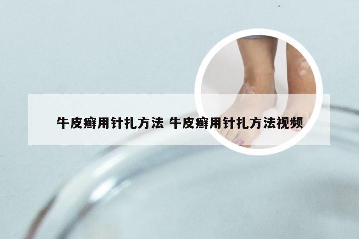 牛皮癣用针扎方法 牛皮癣用针扎方法视频