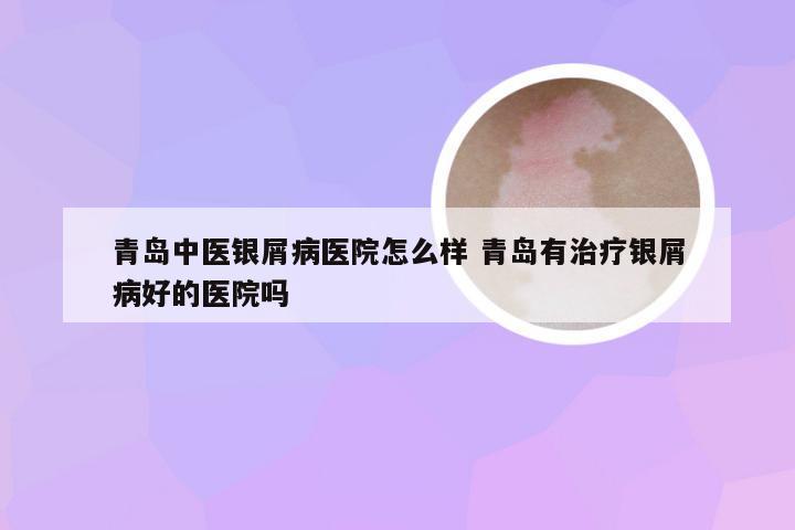 青岛中医银屑病医院怎么样 青岛有治疗银屑病好的医院吗