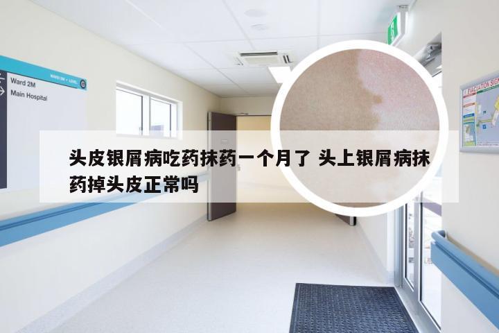 头皮银屑病吃药抹药一个月了 头上银屑病抹药掉头皮正常吗