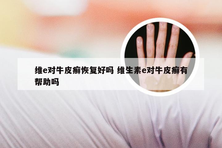 维e对牛皮癣恢复好吗 维生素e对牛皮癣有帮助吗