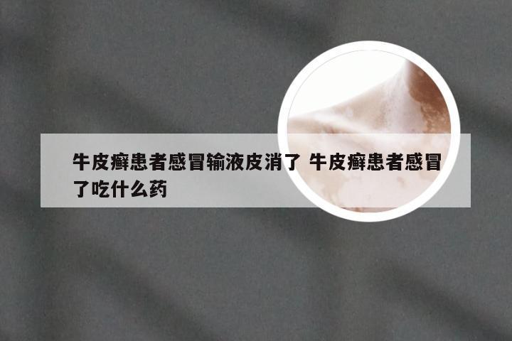 牛皮癣患者感冒输液皮消了 牛皮癣患者感冒了吃什么药