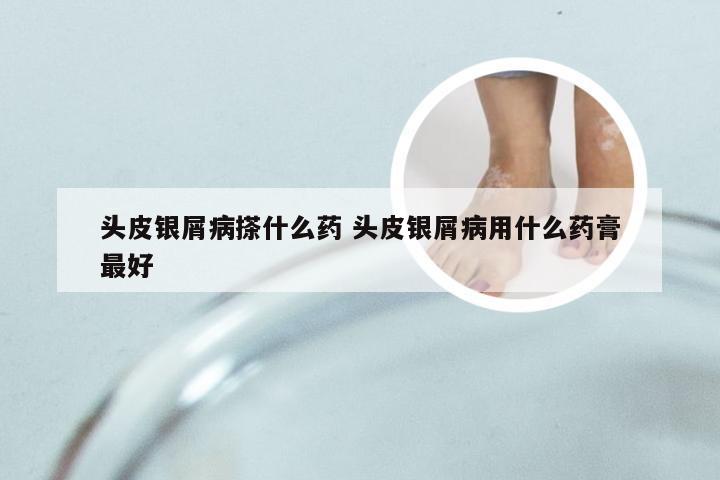 头皮银屑病搽什么药 头皮银屑病用什么药膏最好