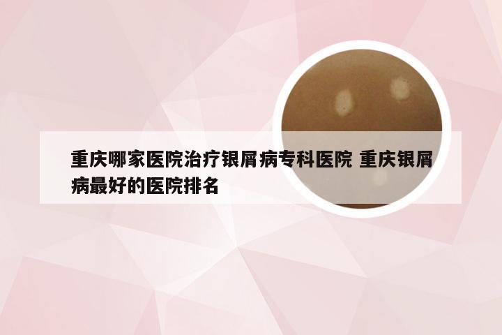 重庆哪家医院治疗银屑病专科医院 重庆银屑病最好的医院排名