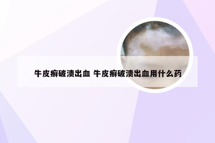 牛皮癣破溃出血 牛皮癣破溃出血用什么药