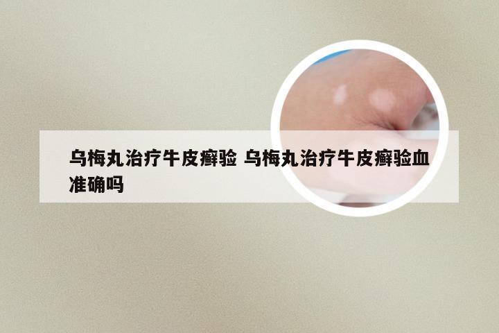 乌梅丸治疗牛皮癣验 乌梅丸治疗牛皮癣验血准确吗
