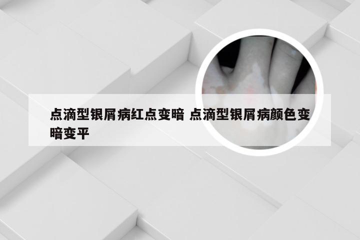 点滴型银屑病红点变暗 点滴型银屑病颜色变暗变平