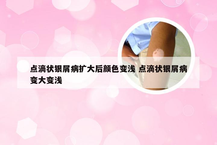 点滴状银屑病扩大后颜色变浅 点滴状银屑病变大变浅