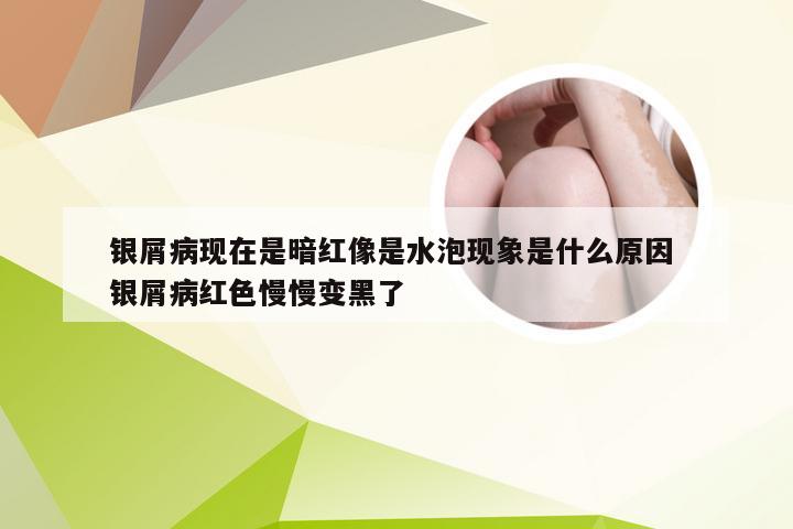银屑病现在是暗红像是水泡现象是什么原因 银屑病红色慢慢变黑了