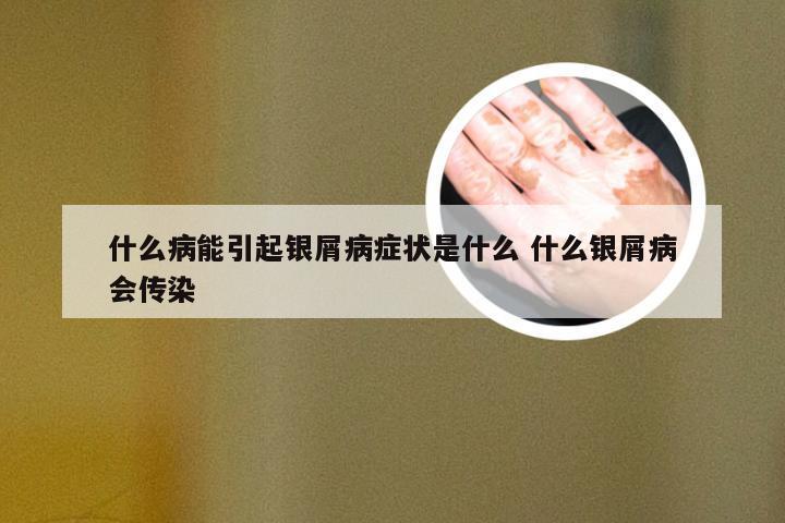 什么病能引起银屑病症状是什么 什么银屑病会传染