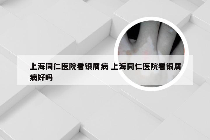 上海同仁医院看银屑病 上海同仁医院看银屑病好吗