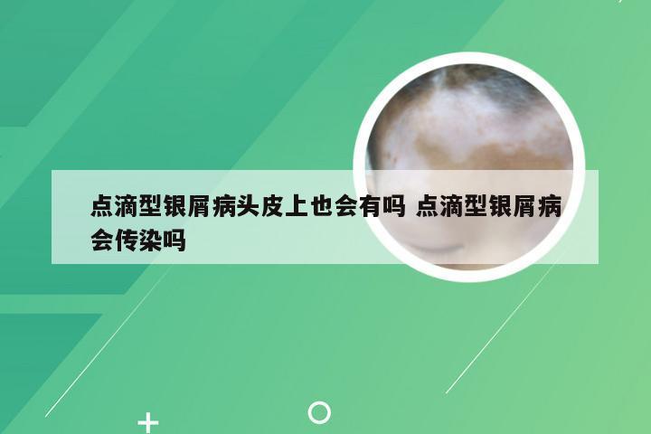 点滴型银屑病头皮上也会有吗 点滴型银屑病会传染吗