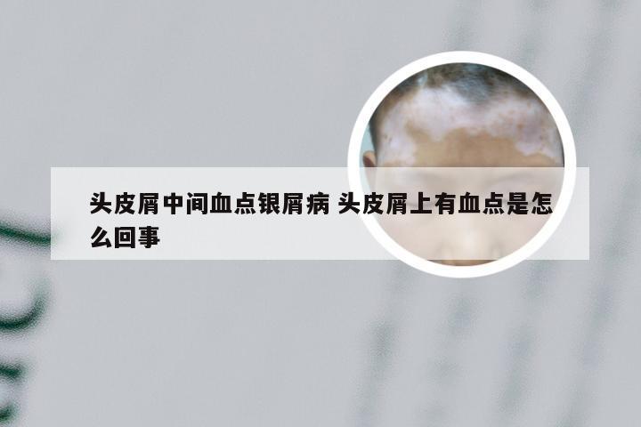头皮屑中间血点银屑病 头皮屑上有血点是怎么回事