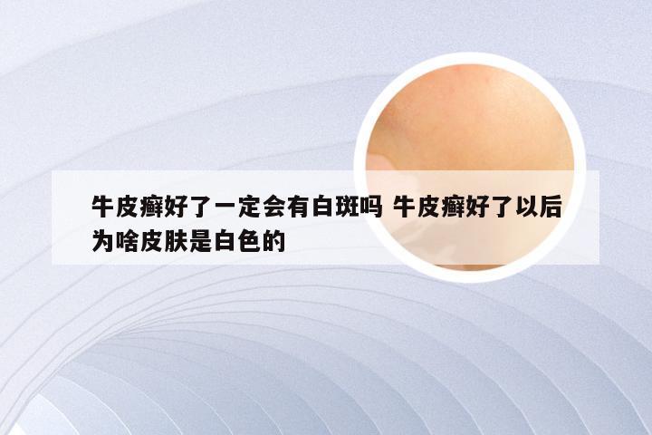 牛皮癣好了一定会有白斑吗 牛皮癣好了以后为啥皮肤是白色的