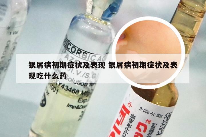 银屑病初期症状及表现 银屑病初期症状及表现吃什么药
