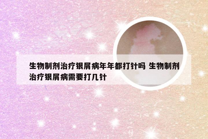 生物制剂治疗银屑病年年都打针吗 生物制剂治疗银屑病需要打几针