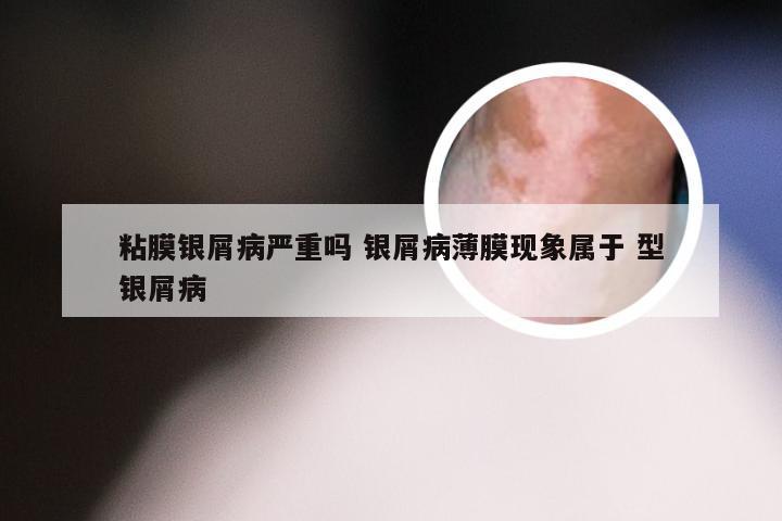粘膜银屑病严重吗 银屑病薄膜现象属于 型银屑病