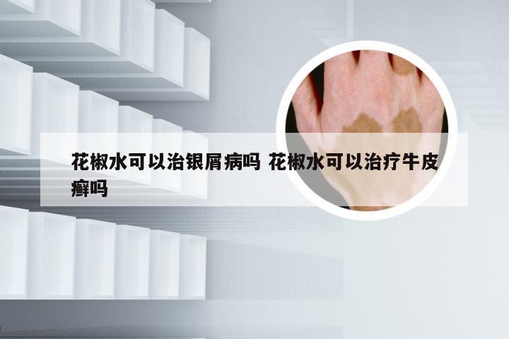 花椒水可以治银屑病吗 花椒水可以治疗牛皮癣吗