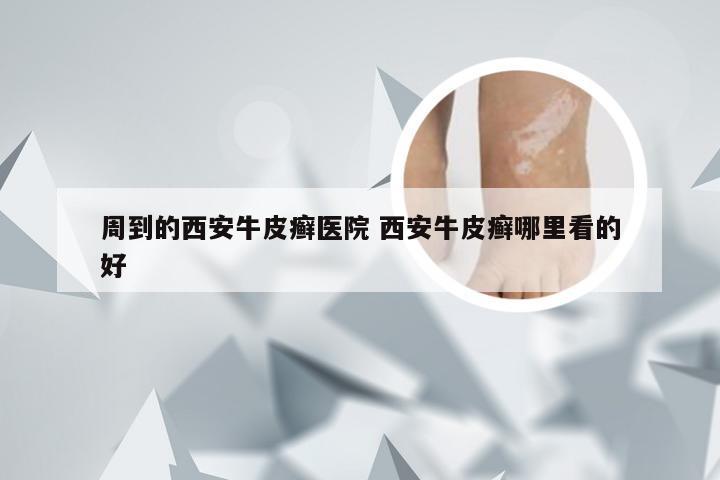 周到的西安牛皮癣医院 西安牛皮癣哪里看的好