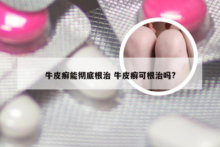 牛皮癣能彻底根治 牛皮癣可根治吗?