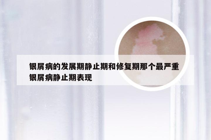 银屑病的发展期静止期和修复期那个最严重 银屑病静止期表现