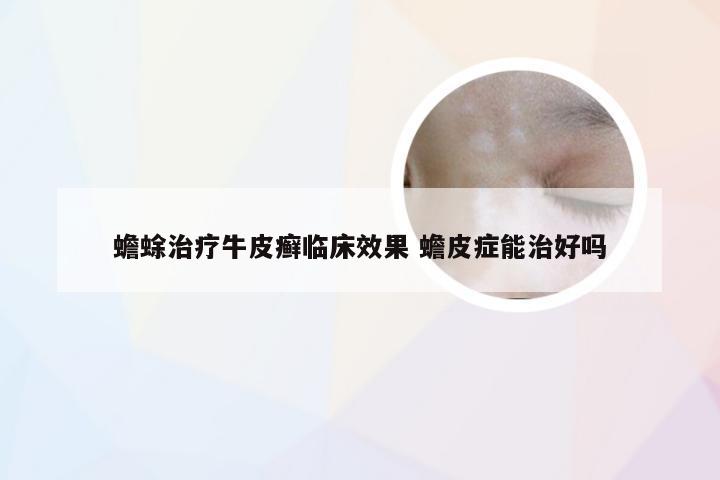 蟾蜍治疗牛皮癣临床效果 蟾皮症能治好吗