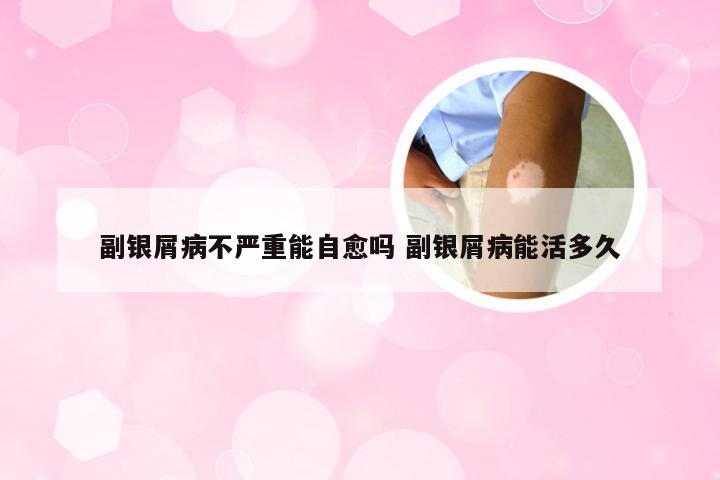 副银屑病不严重能自愈吗 副银屑病能活多久
