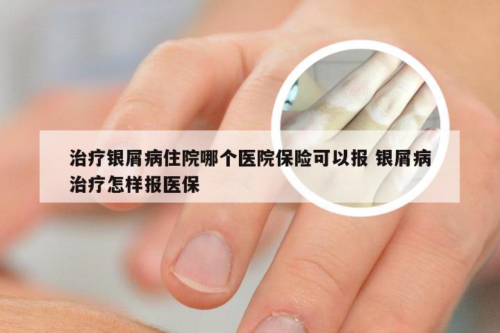治疗银屑病住院哪个医院保险可以报 银屑病治疗怎样报医保
