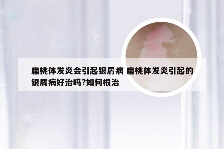 扁桃体发炎会引起银屑病 扁桃体发炎引起的银屑病好治吗?如何根治