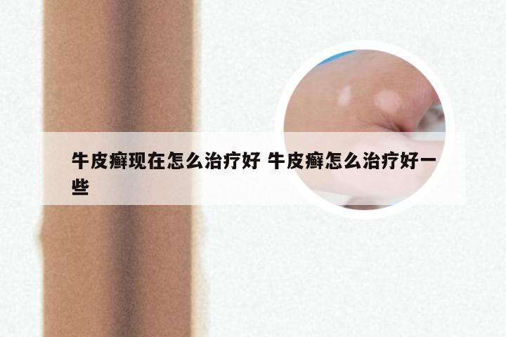 牛皮癣现在怎么治疗好 牛皮癣怎么治疗好一些
