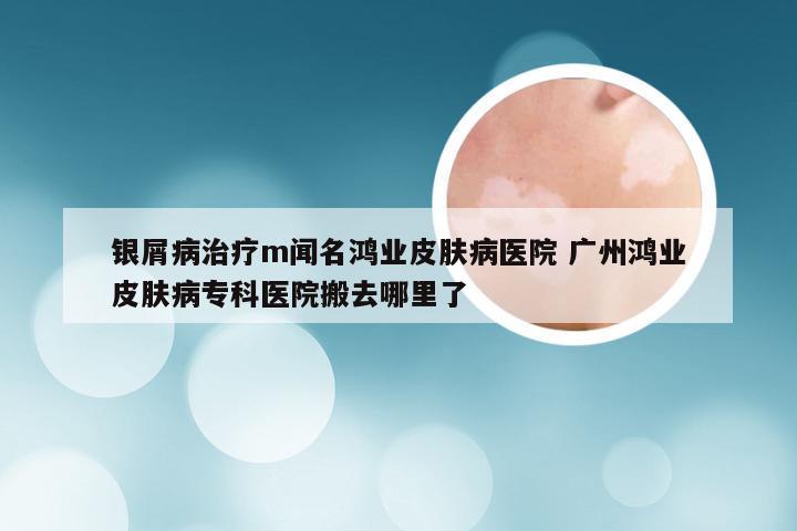 银屑病治疗m闻名鸿业皮肤病医院 广州鸿业皮肤病专科医院搬去哪里了