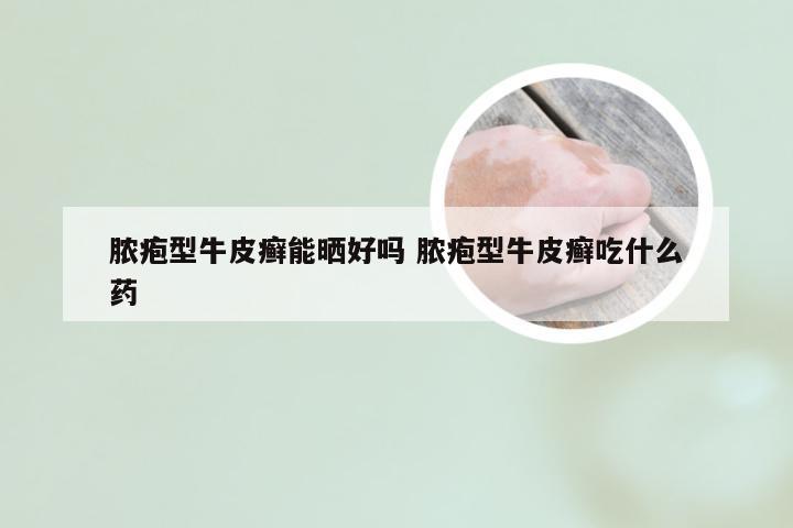 脓疱型牛皮癣能晒好吗 脓疱型牛皮癣吃什么药