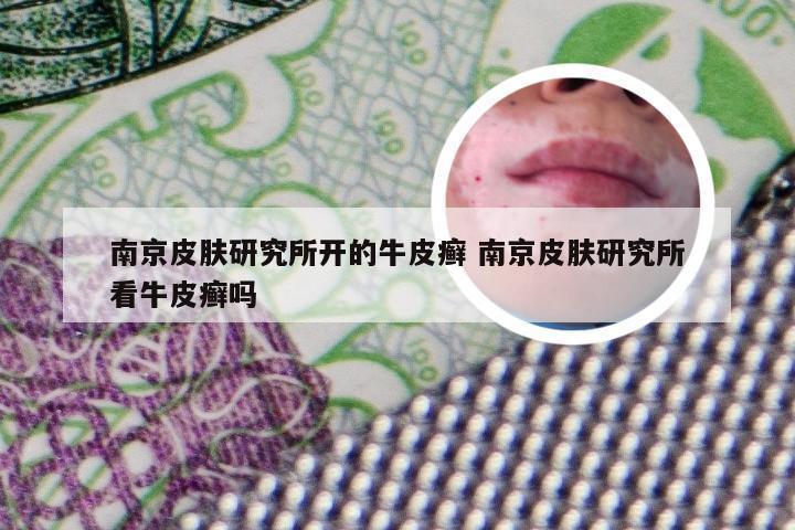 南京皮肤研究所开的牛皮癣 南京皮肤研究所看牛皮癣吗
