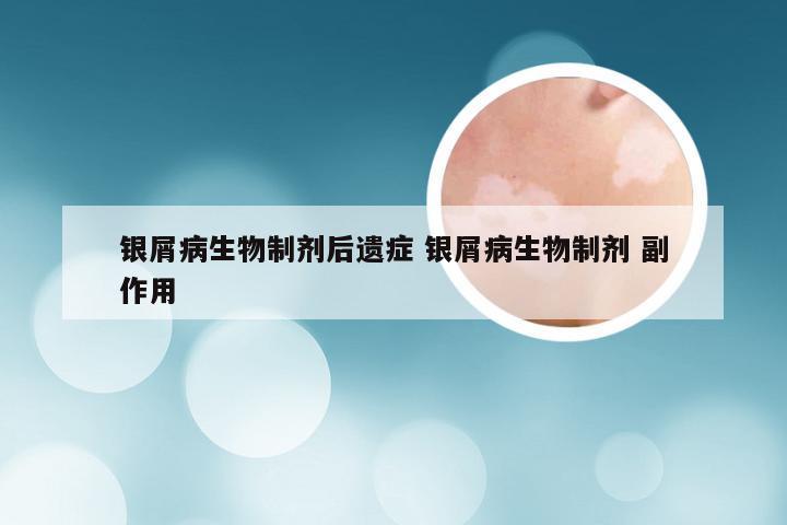 银屑病生物制剂后遗症 银屑病生物制剂 副作用