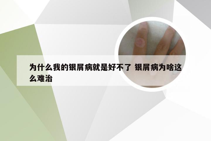 为什么我的银屑病就是好不了 银屑病为啥这么难治