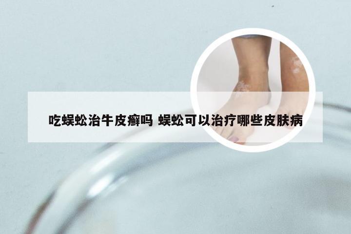 吃蜈蚣治牛皮癣吗 蜈蚣可以治疗哪些皮肤病