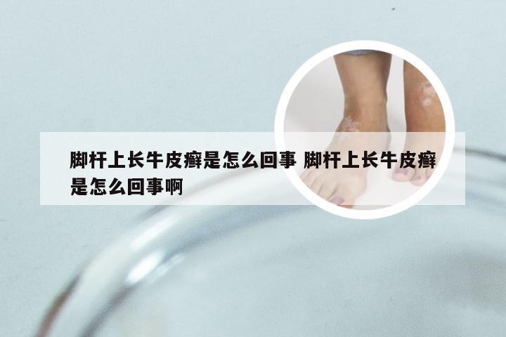 脚杆上长牛皮癣是怎么回事 脚杆上长牛皮癣是怎么回事啊