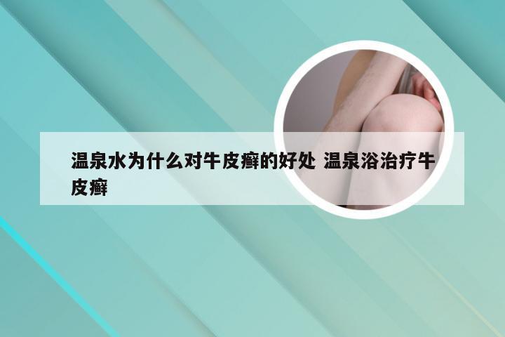 温泉水为什么对牛皮癣的好处 温泉浴治疗牛皮癣