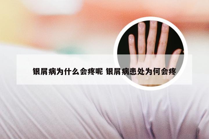 银屑病为什么会疼呢 银屑病患处为何会疼