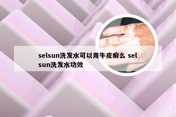 selsun洗发水可以用牛皮癣么 selsun洗发水功效