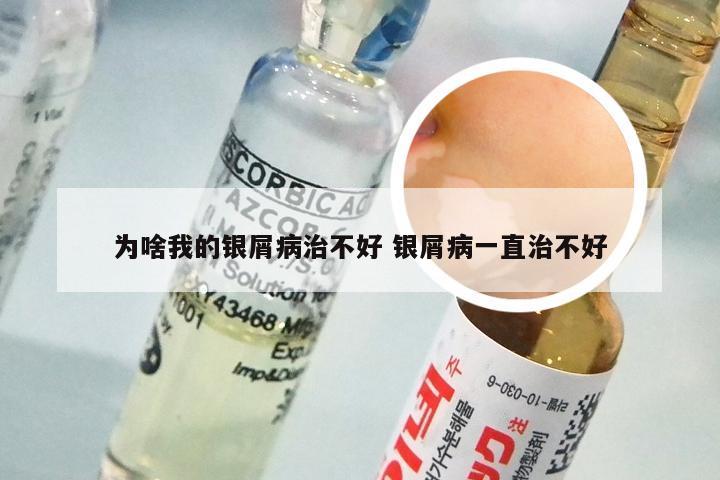 为啥我的银屑病治不好 银屑病一直治不好