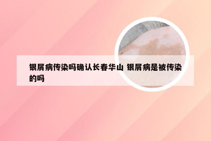 银屑病传染吗确认长春华山 银屑病是被传染的吗